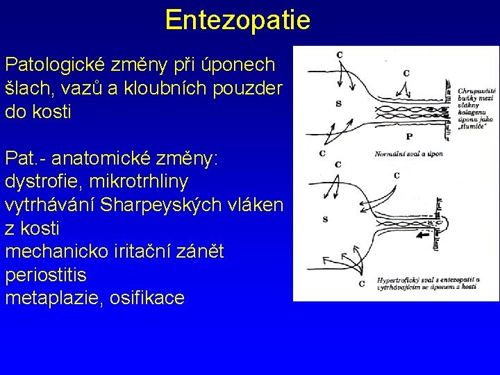 Entezopatie Patologické změny při úponech šlach, vazů a kloubních pouzder do kosti Pat. -