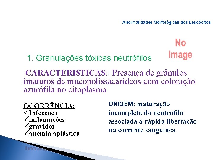 Anormalidades Morfológicas dos Leucócitos 1. Granulações tóxicas neutrófilos CARACTERISTICAS: Presença de grânulos imaturos de