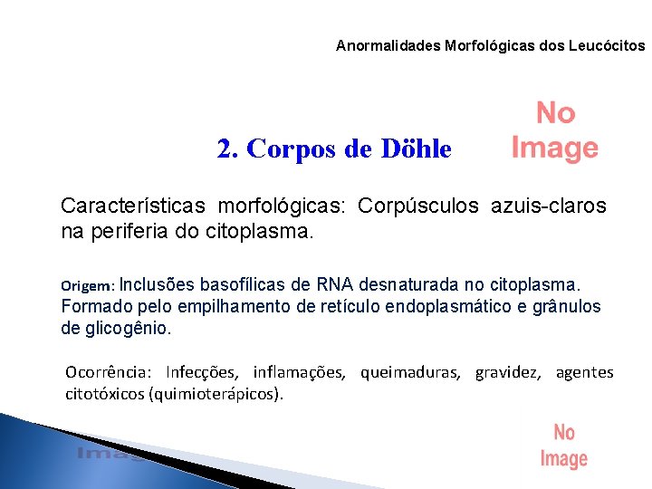 Anormalidades Morfológicas dos Leucócitos 2. Corpos de Döhle Características morfológicas: Corpúsculos azuis-claros na periferia