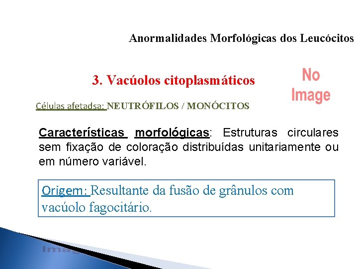 Anormalidades Morfológicas dos Leucócitos 3. Vacúolos citoplasmáticos Células afetadsa: NEUTRÓFILOS / MONÓCITOS Características morfológicas: