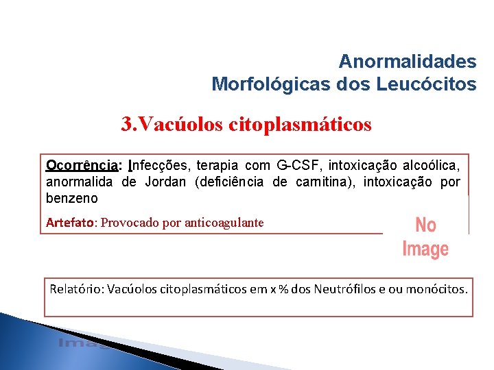 Anormalidades Morfológicas dos Leucócitos 3. Vacúolos citoplasmáticos Ocorrência: Infecções, terapia com G-CSF, intoxicação alcoólica,