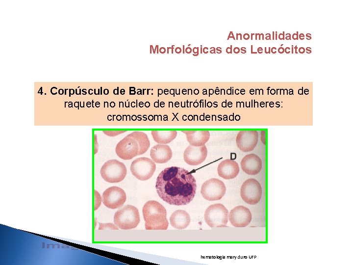 Anormalidades Morfológicas dos Leucócitos 4. Corpúsculo de Barr: pequeno apêndice em forma de raquete