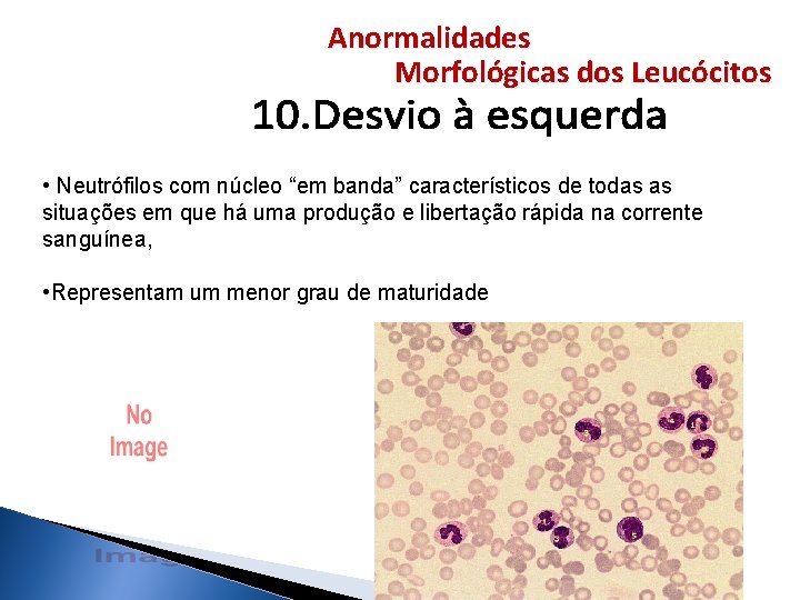 Anormalidades Morfológicas dos Leucócitos • Neutrófilos com núcleo “em banda” característicos de todas as