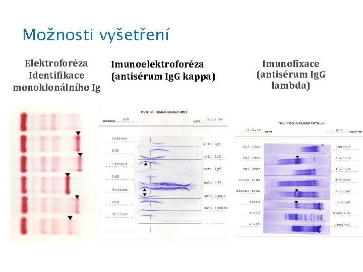 Možnosti vyšetření Elektroforéza Identifikace monoklonálního Ig Imunoelektroforéza (antisérum Ig. G kappa) Imunofixace (antisérum Ig.