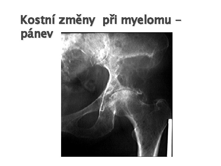 Kostní změny při myelomu pánev 