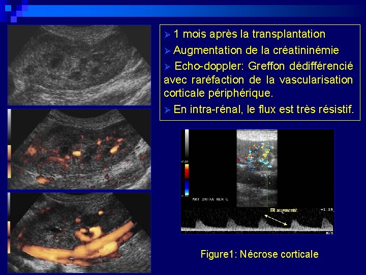 Ø 1 mois après la transplantation Ø Augmentation de la créatininémie Ø Echo-doppler: Greffon