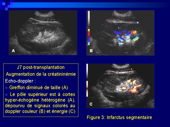 A J 7 post-transplantation Augmentation de la créatininémie Echo-doppler : Ø Greffon diminué de