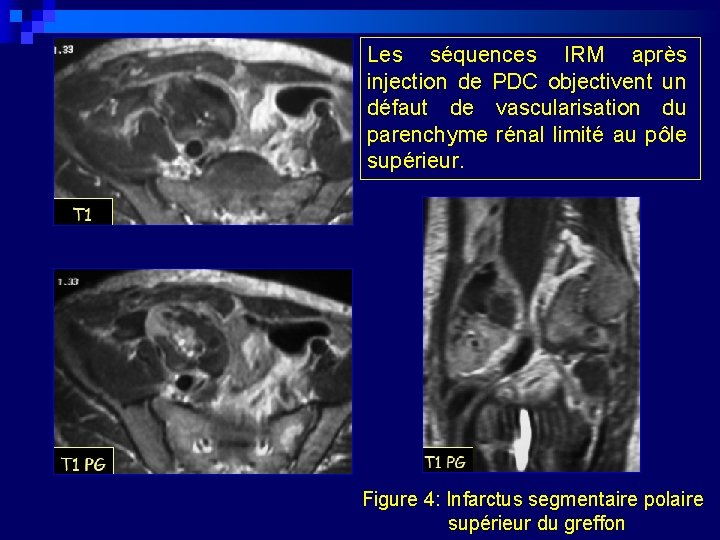 Les séquences IRM après injection de PDC objectivent un défaut de vascularisation du parenchyme