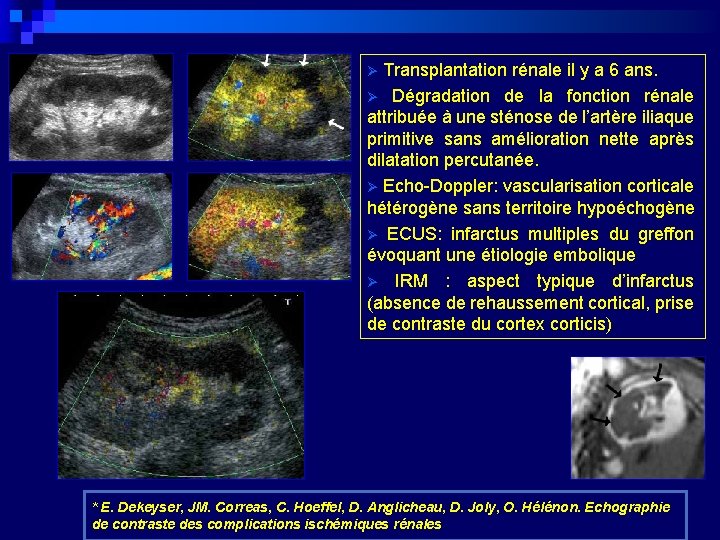 Ø Transplantation rénale il y a 6 ans. Ø Dégradation de la fonction rénale