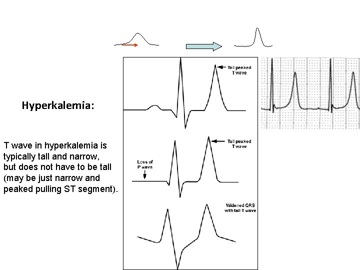 Hyperkalemia: T wave in hyperkalemia is typically tall and narrow, but does not have