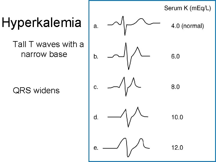 Hyperkalemia Tall T waves with a narrow base QRS widens 