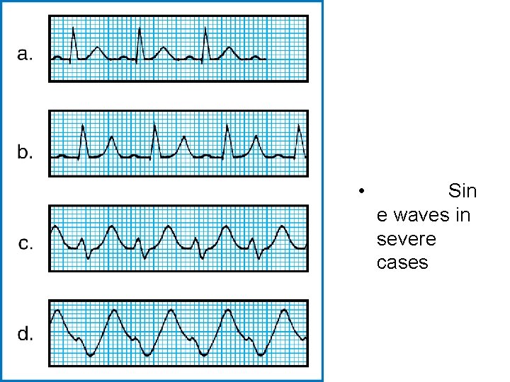  • Sin e waves in severe cases 