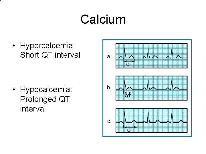 Calcium • Hypercalcemia: Short QT interval • Hypocalcemia: Prolonged QT interval 