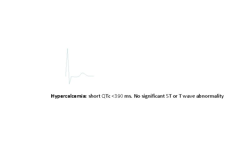 Hypercalcemia: short QTc <390 ms. No significant ST or T wave abnormality 