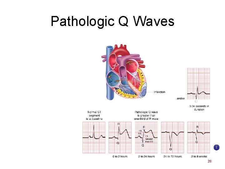 Pathologic Q Waves I 28 