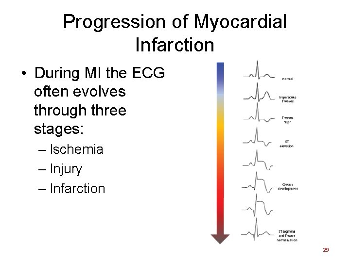 Progression of Myocardial Infarction • During MI the ECG often evolves through three stages: