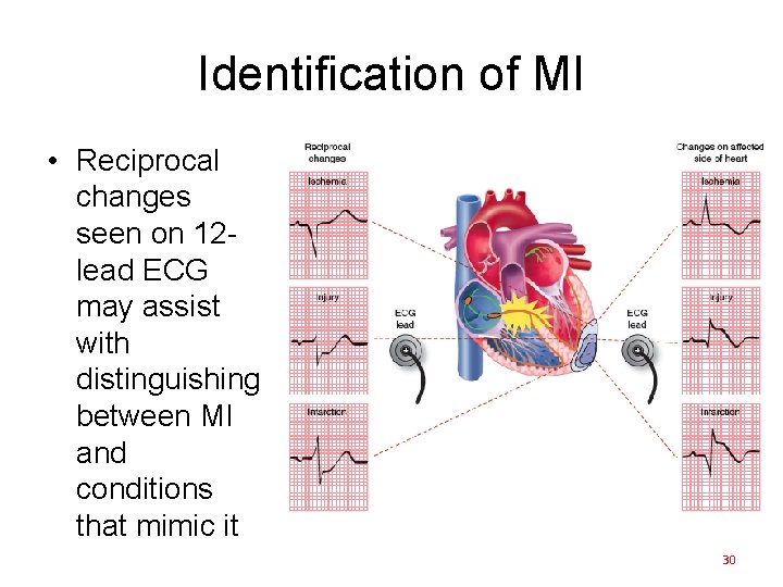 Identification of MI • Reciprocal changes seen on 12 lead ECG may assist with