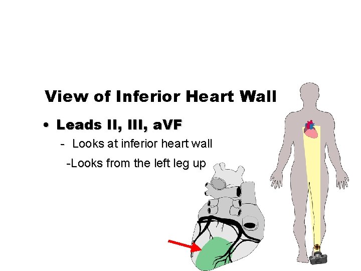 View of Inferior Heart Wall • Leads II, III, a. VF - Looks at