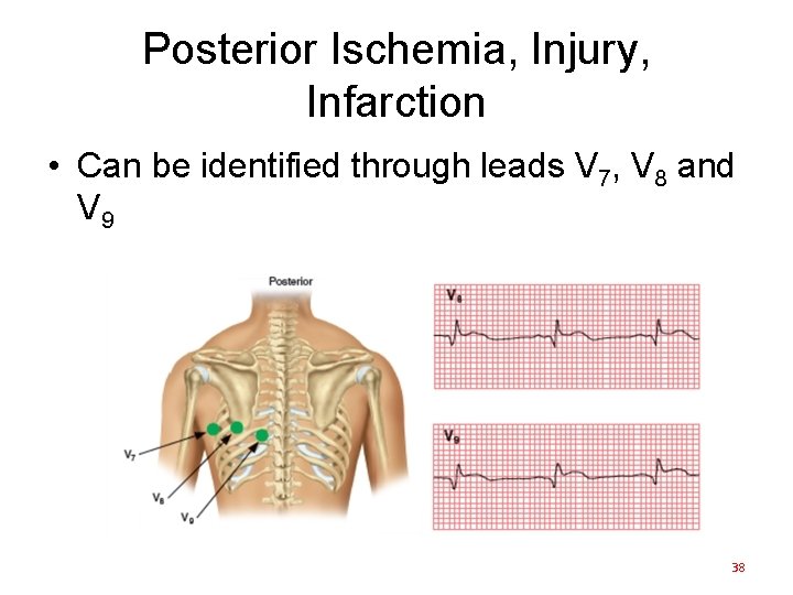 Posterior Ischemia, Injury, Infarction • Can be identified through leads V 7, V 8