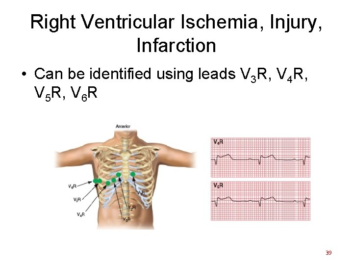 Right Ventricular Ischemia, Injury, Infarction • Can be identified using leads V 3 R,