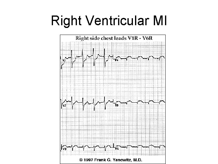 Right Ventricular MI 