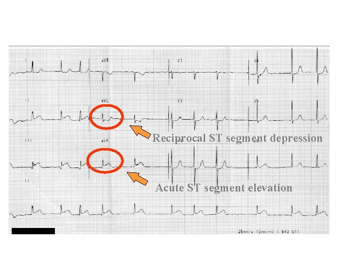 Reciprocal ST segment depression Acute ST segment elevation 