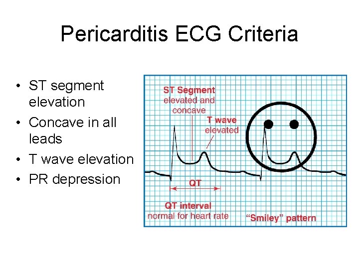 Pericarditis ECG Criteria • ST segment elevation • Concave in all leads • T