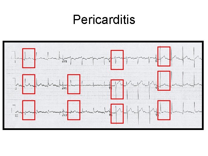 Pericarditis 