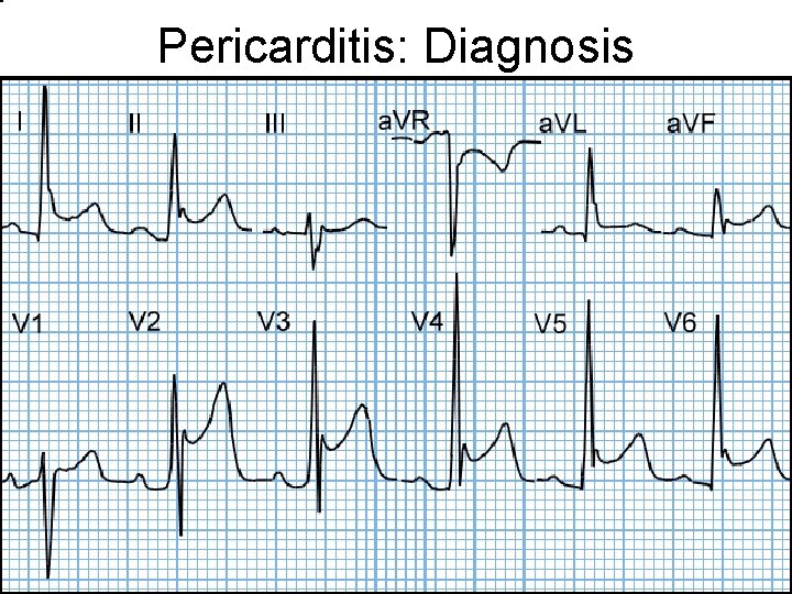 Pericarditis: Diagnosis 