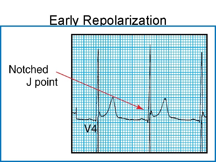 Early Repolarization 