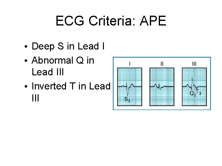 ECG Criteria: APE • Deep S in Lead I • Abnormal Q in Lead