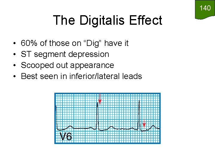 140 The Digitalis Effect • • 60% of those on “Dig” have it ST