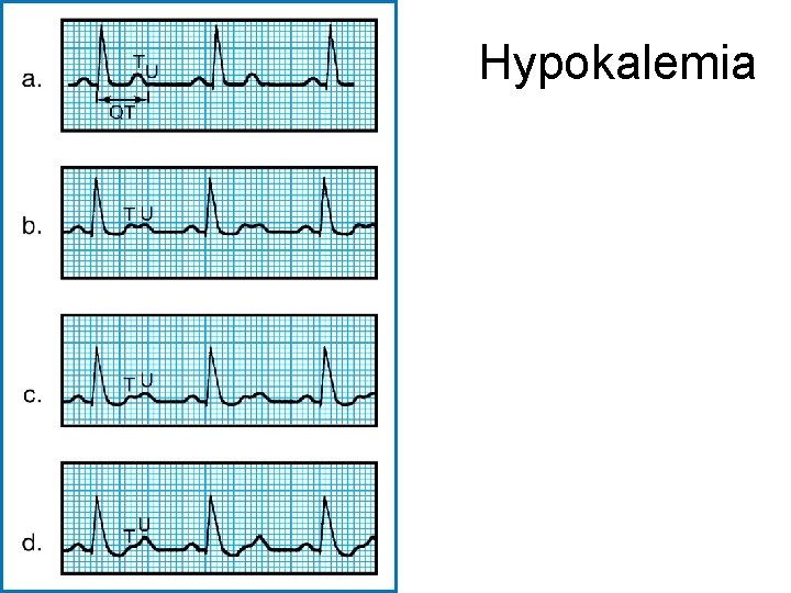 Hypokalemia 