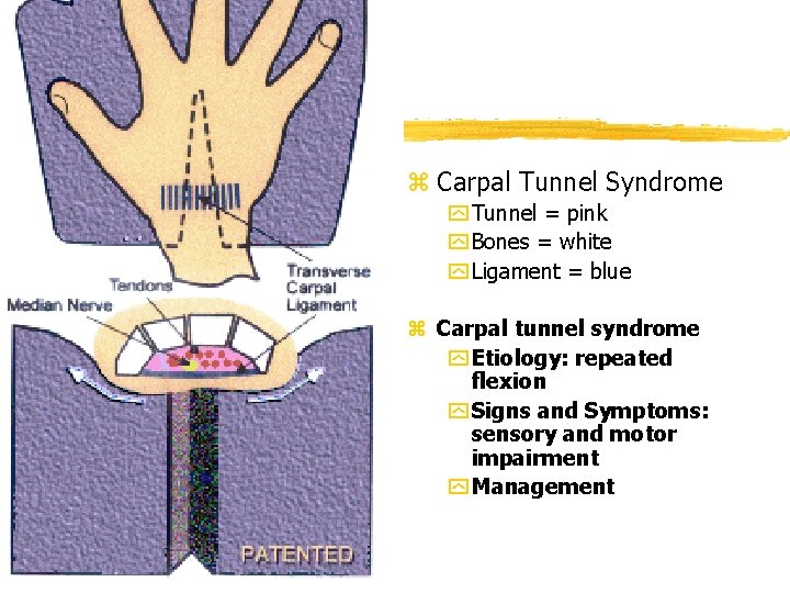 z Carpal Tunnel Syndrome y Tunnel = pink y Bones = white y Ligament z Carpal Tunnel Syndrome y Tunnel = pink y Bones = white y Ligament