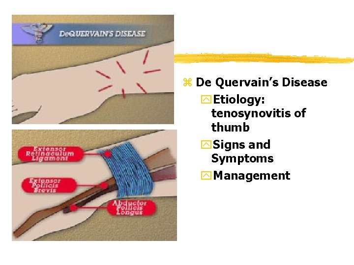 z De Quervain’s Disease y. Etiology: tenosynovitis of thumb y. Signs and Symptoms y. z De Quervain’s Disease y. Etiology: tenosynovitis of thumb y. Signs and Symptoms y.