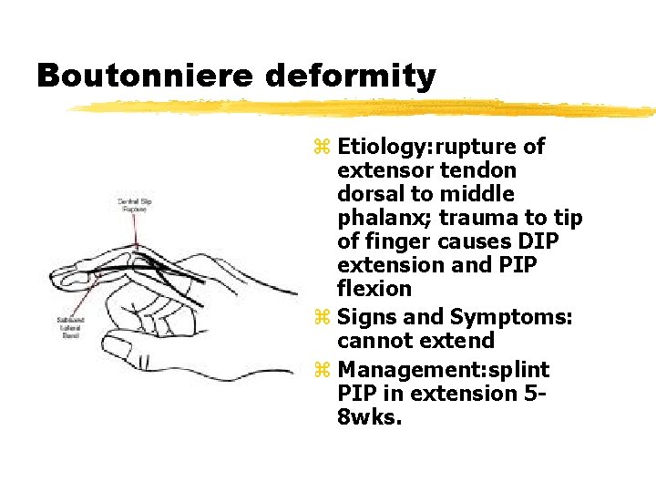 Boutonniere deformity z Etiology: rupture of extensor tendon dorsal to middle phalanx; trauma to Boutonniere deformity z Etiology: rupture of extensor tendon dorsal to middle phalanx; trauma to