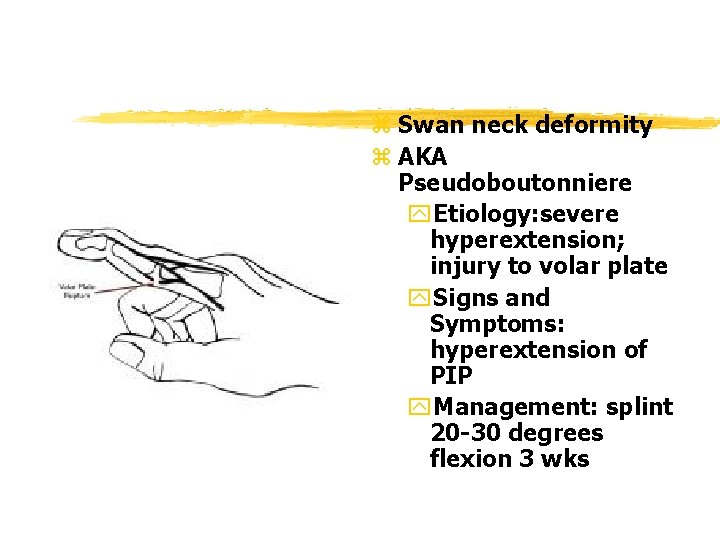 z Swan neck deformity z AKA Pseudoboutonniere y. Etiology: severe hyperextension; injury to volar z Swan neck deformity z AKA Pseudoboutonniere y. Etiology: severe hyperextension; injury to volar