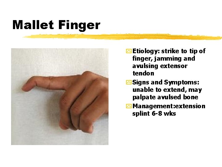 Mallet Finger y Etiology: strike to tip of finger, jamming and avulsing extensor tendon Mallet Finger y Etiology: strike to tip of finger, jamming and avulsing extensor tendon
