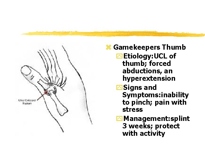 z Gamekeepers Thumb y. Etiology: UCL of thumb; forced abductions, an hyperextension y. Signs z Gamekeepers Thumb y. Etiology: UCL of thumb; forced abductions, an hyperextension y. Signs