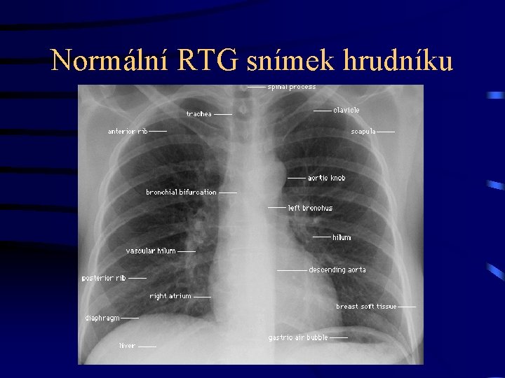 Normální RTG snímek hrudníku 