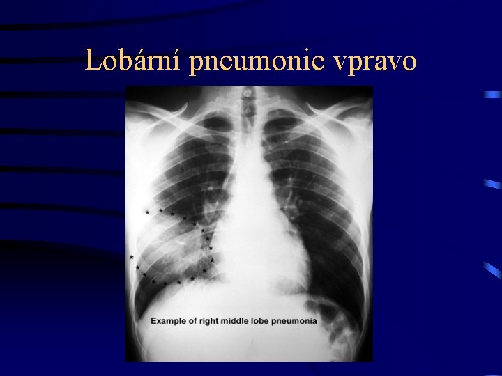 Lobární pneumonie vpravo 