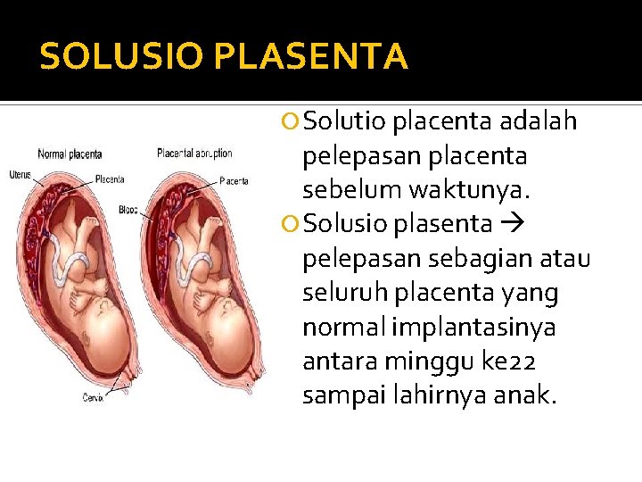 SOLUSIO PLASENTA Solutio placenta adalah pelepasan placenta sebelum waktunya. Solusio plasenta pelepasan sebagian atau