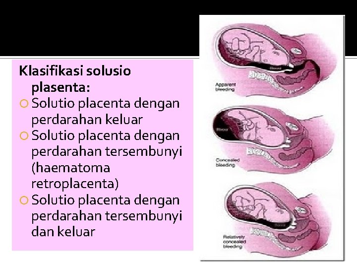 Klasifikasi solusio plasenta: Solutio placenta dengan perdarahan keluar Solutio placenta dengan perdarahan tersembunyi (haematoma