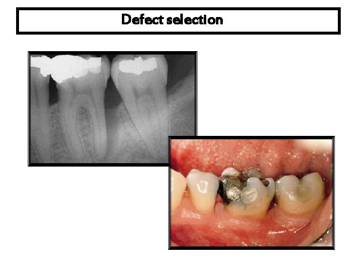 Defect selection 