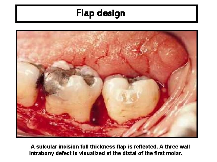 Flap design A sulcular incision full thickness flap is reflected. A three wall intrabony