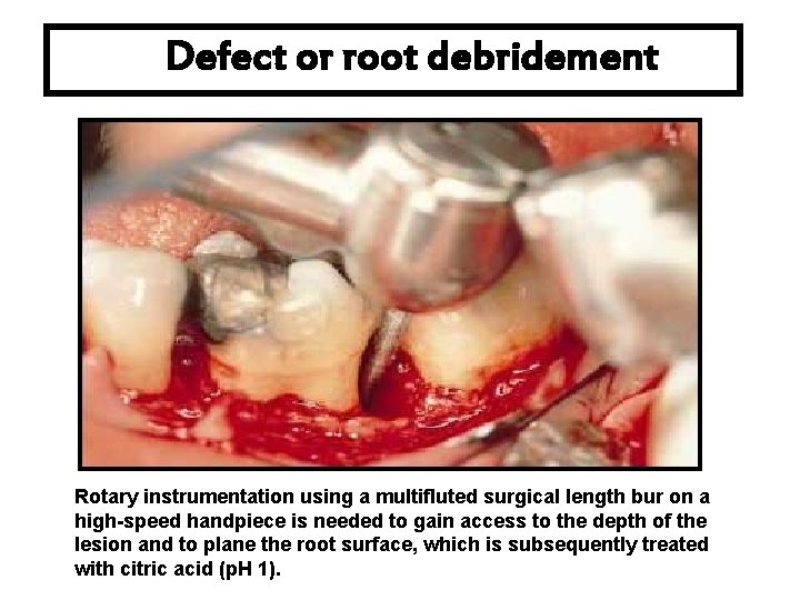 Defect or root debridement Rotary instrumentation using a multifluted surgical length bur on a