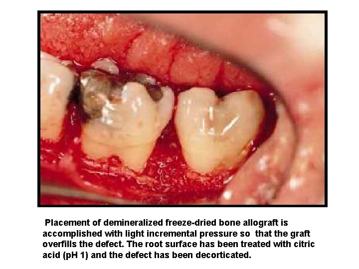 Placement of demineralized freeze-dried bone allograft is accomplished with light incremental pressure so that