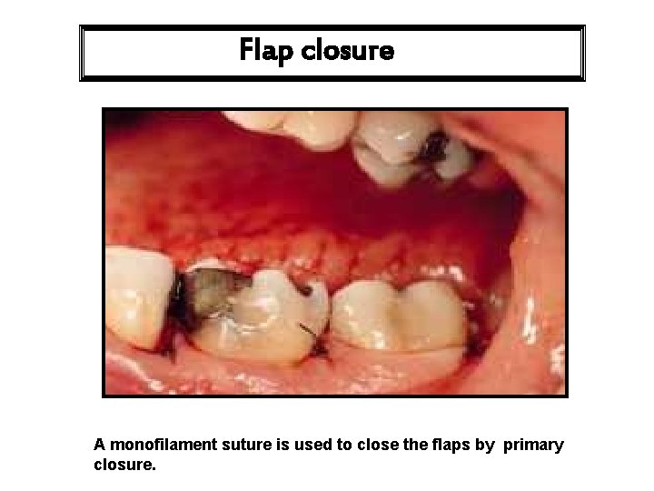 Flap closure A monofilament suture is used to close the flaps by primary closure.