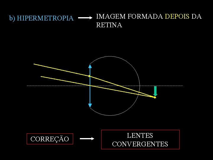b) HIPERMETROPIA CORREÇÃO IMAGEM FORMADA DEPOIS DA RETINA LENTES CONVERGENTES 