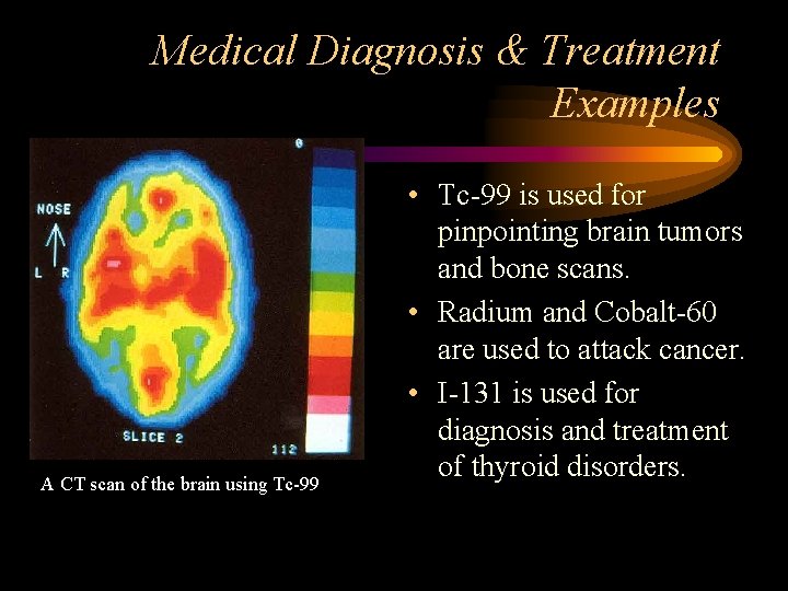 Medical Diagnosis & Treatment Examples A CT scan of the brain using Tc-99 •